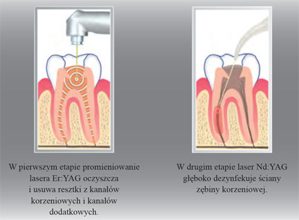 endo-laser